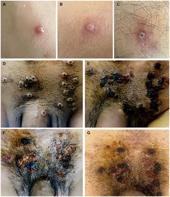 Cases of Monkeypox show highly-overlapping co-infection with HIV and syphilis